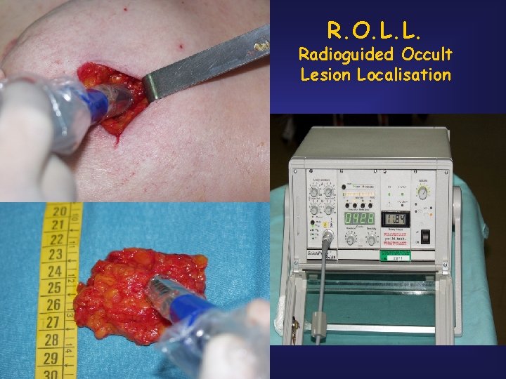 R. O. L. L. Radioguided Occult Lesion Localisation 