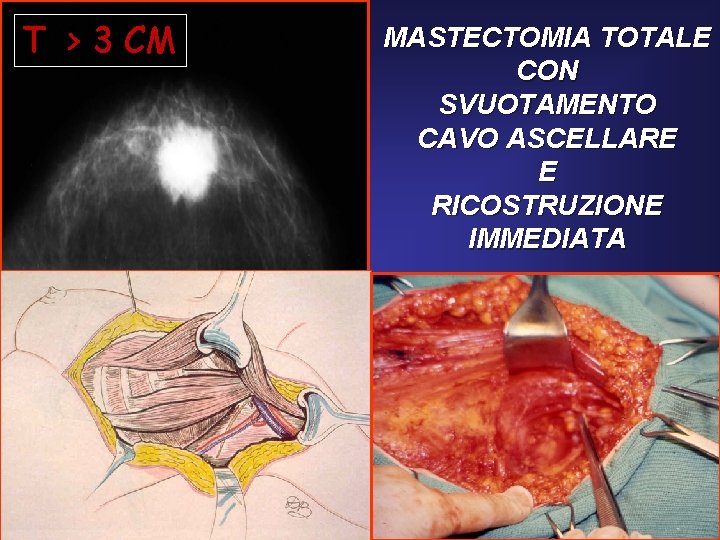 T > 3 CM MASTECTOMIA TOTALE CON SVUOTAMENTO CAVO ASCELLARE E RICOSTRUZIONE IMMEDIATA 