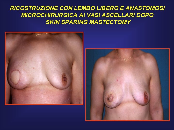 RICOSTRUZIONE CON LEMBO LIBERO E ANASTOMOSI MICROCHIRURGICA AI VASI ASCELLARI DOPO SKIN SPARING MASTECTOMY