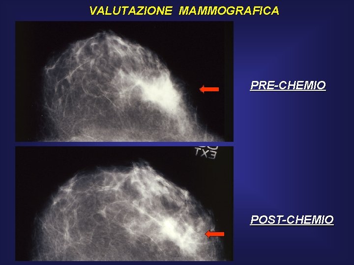 VALUTAZIONE MAMMOGRAFICA PRE-CHEMIO POST-CHEMIO 