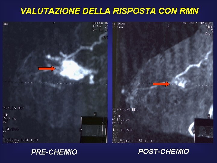 VALUTAZIONE DELLA RISPOSTA CON RMN PRE-CHEMIO POST-CHEMIO 