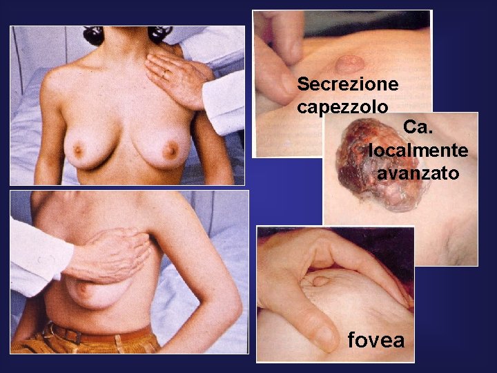Secrezione capezzolo Ca. localmente avanzato fovea 