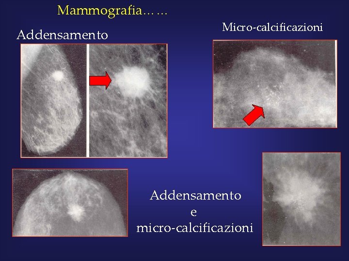 Mammografia…… Addensamento Micro-calcificazioni Addensamento e micro-calcificazioni 