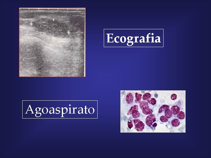 Ecografia Agoaspirato 