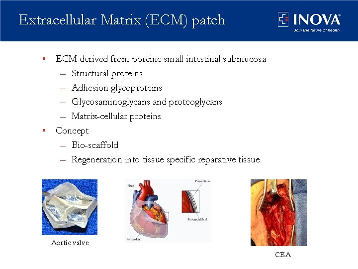 Extracellular Matrix (ECM) patch • ECM derived from porcine small intestinal submucosa – Structural