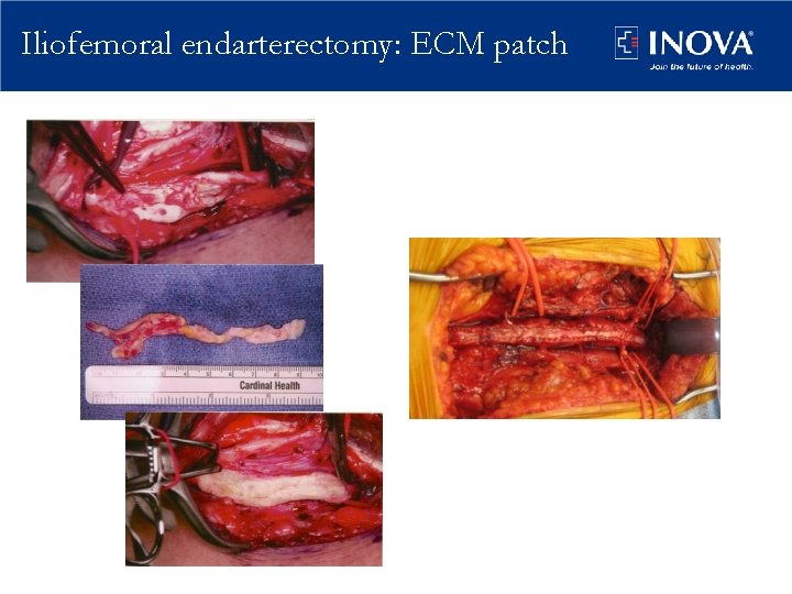 Iliofemoral endarterectomy: ECM patch 