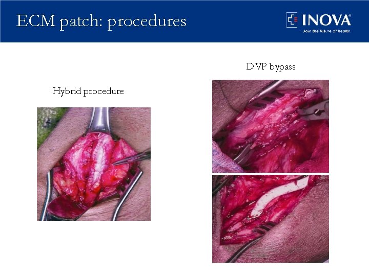 ECM patch: procedures DVP bypass Hybrid procedure 