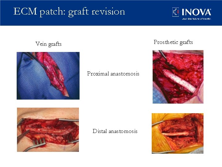 ECM patch: graft revision Prosthetic grafts Vein grafts Proximal anastomosis Distal anastomosis 