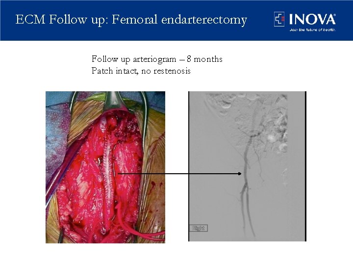 ECM Follow up: Femoral endarterectomy Follow up arteriogram – 8 months Patch intact, no