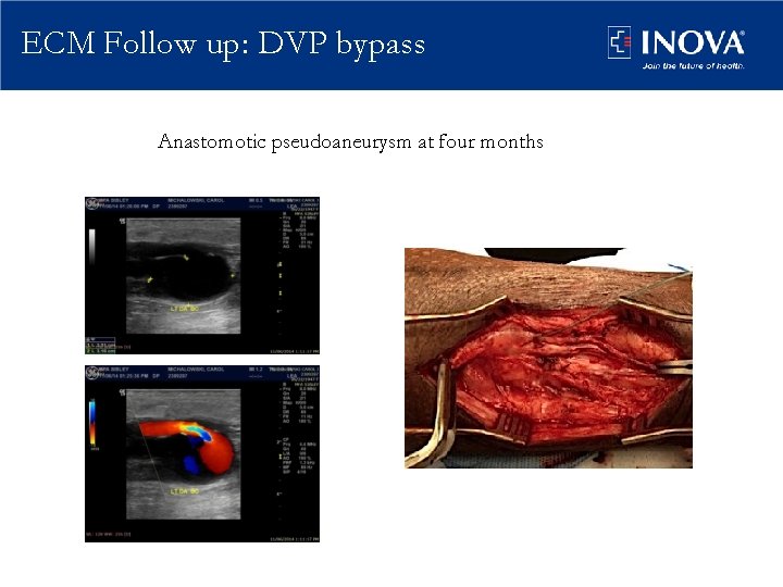 ECM Follow up: DVP bypass Anastomotic pseudoaneurysm at four months 