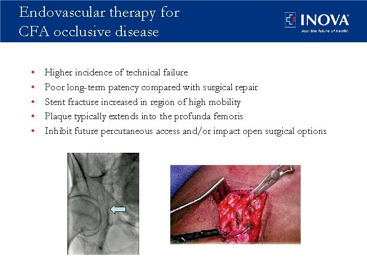 Endovascular therapy for CFA occlusive disease • • • Higher incidence of technical failure