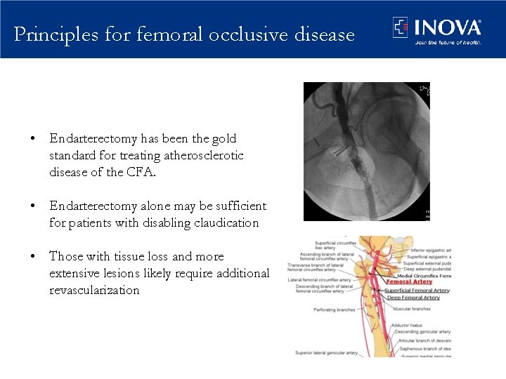 Principles for femoral occlusive disease • Endarterectomy has been the gold standard for treating