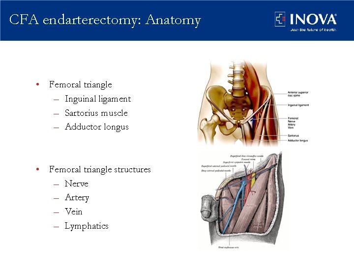 CFA endarterectomy: Anatomy • Femoral triangle – Inguinal ligament – Sartorius muscle – Adductor