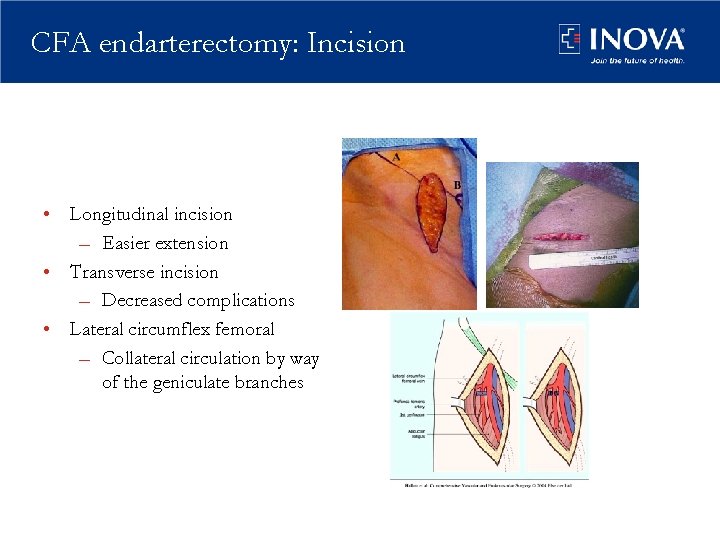 CFA endarterectomy: Incision • Longitudinal incision – Easier extension • Transverse incision – Decreased