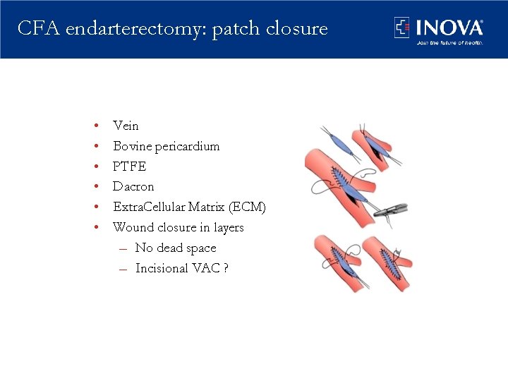 CFA endarterectomy: patch closure • • • Vein Bovine pericardium PTFE Dacron Extra. Cellular
