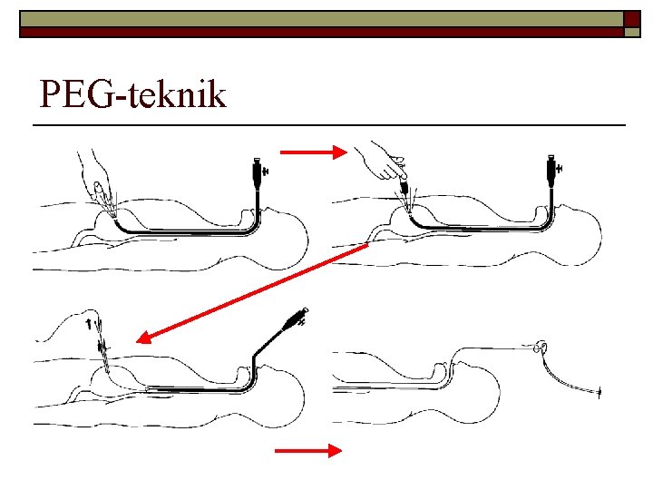 PEG-teknik 