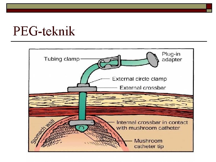 PEG-teknik 