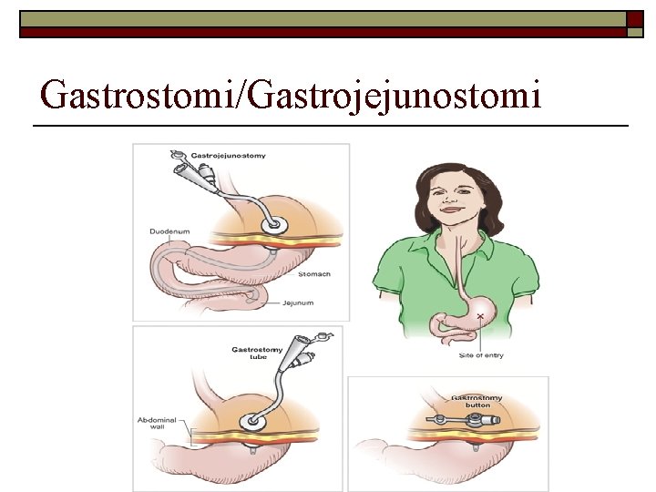 Gastrostomi/Gastrojejunostomi 