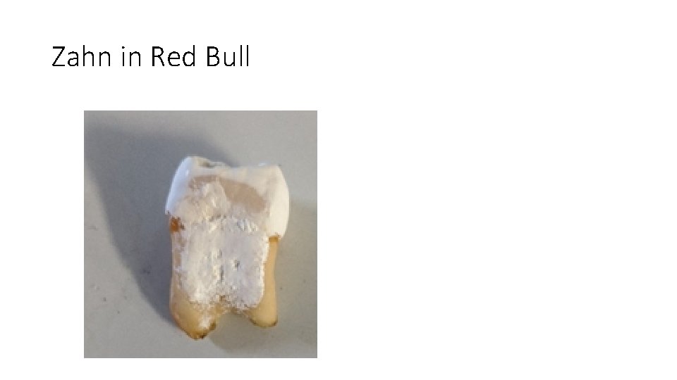 Zahn in Red Bull 