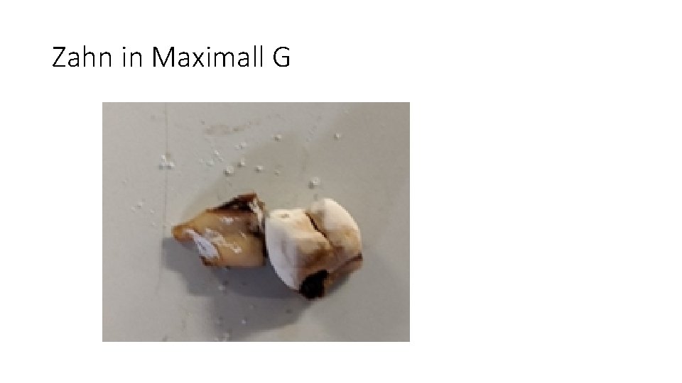 Zahn in Maximall G 