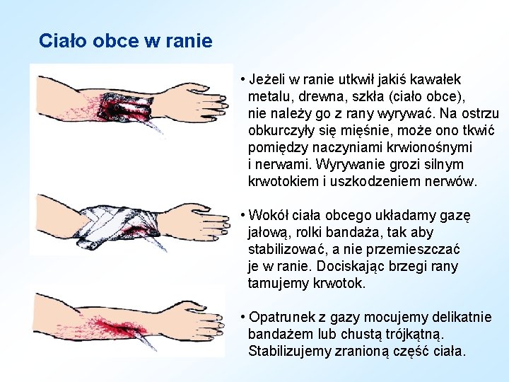 Ciało obce w ranie • Jeżeli w ranie utkwił jakiś kawałek metalu, drewna, szkła