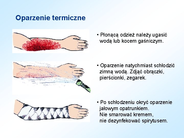 Oparzenie termiczne • Płonącą odzież należy ugasić wodą lub kocem gaśniczym. • Oparzenie natychmiast