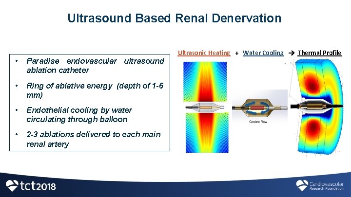 Ultrasound Based Renal Denervation • Paradise endovascular ultrasound ablation catheter • Ring of ablative