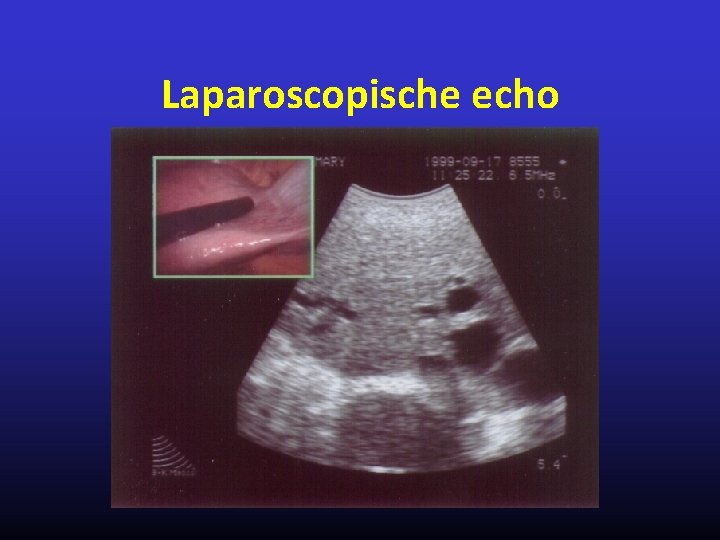 Laparoscopische echo 