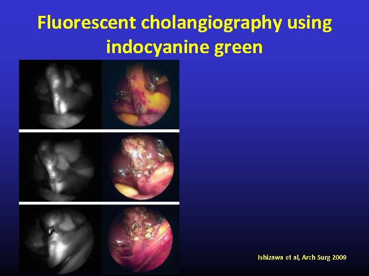 Fluorescent cholangiography using indocyanine green Ishizawa et al, Arch Surg 2009 