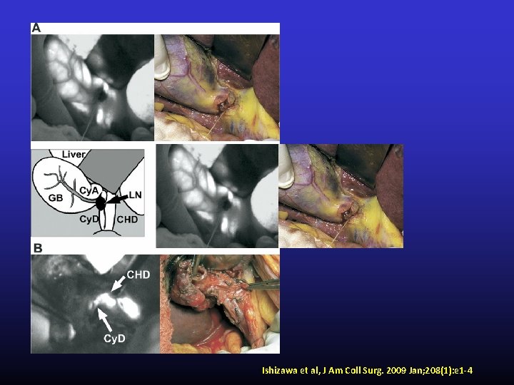 Ishizawa et al, J Am Coll Surg. 2009 Jan; 208(1): e 1 -4 