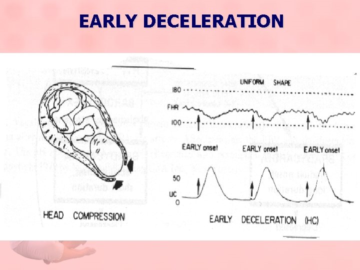 EARLY DECELERATION 