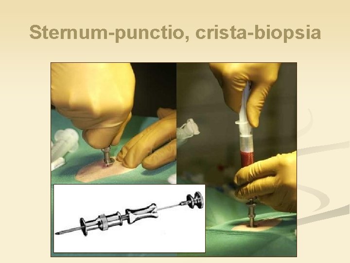 Sternum-punctio, crista-biopsia 