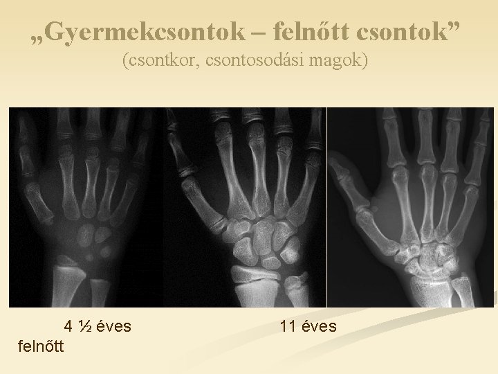 „Gyermekcsontok – felnőtt csontok” (csontkor, csontosodási magok) 4 ½ éves felnőtt 11 éves 