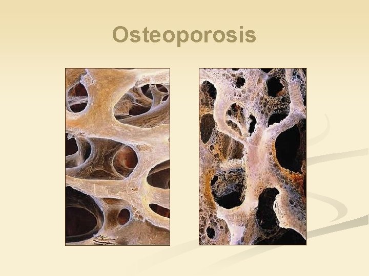 Osteoporosis 