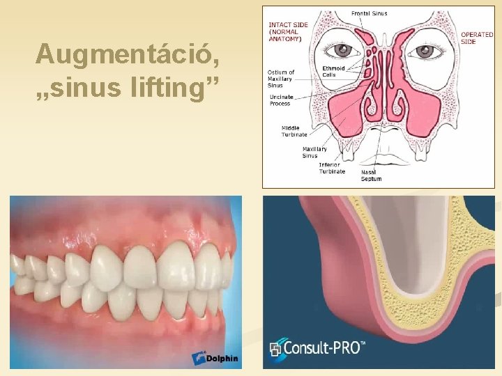 Augmentáció, „sinus lifting” 