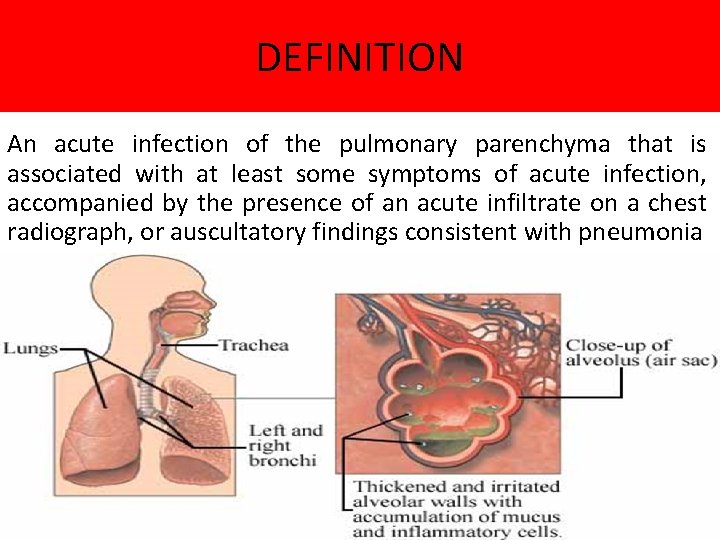 DEFINITION An acute infection of the pulmonary parenchyma that is associated with at least