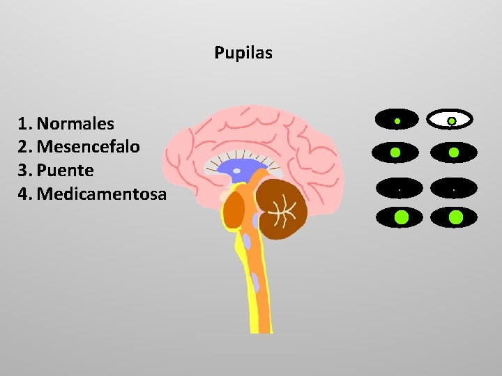 Pupilas 1. Normales 2. Mesencefalo 3. Puente 4. Medicamentosa 