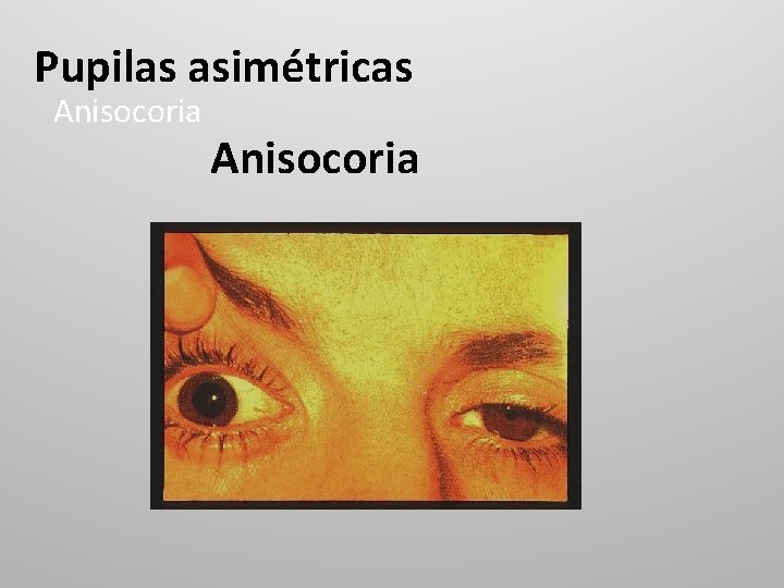 Pupilas asimétricas Anisocoria 