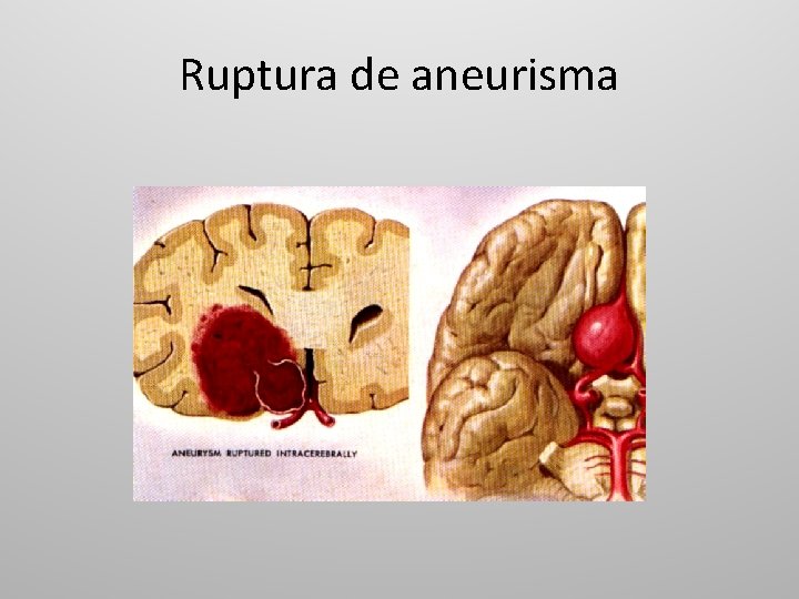 Ruptura de aneurisma 