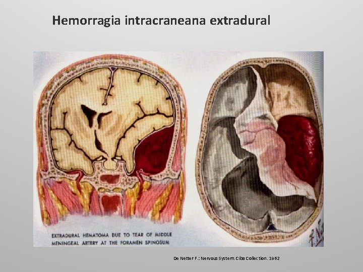 Hemorragia intracraneana extradural De Netter F. : Nervous System. Ciba Collection. 1962 