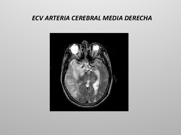 ECV ARTERIA CEREBRAL MEDIA DERECHA 