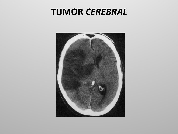 TUMOR CEREBRAL 