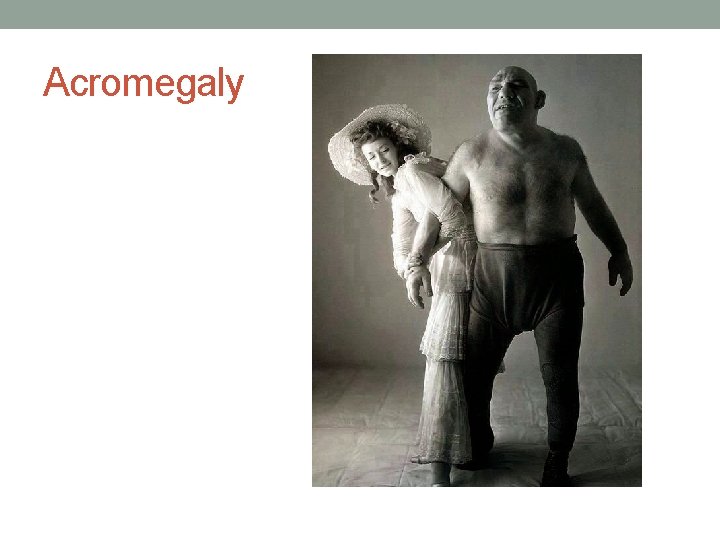 Acromegaly 