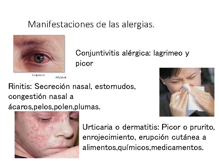 Manifestaciones de las alergias. Conjuntivitis alérgica: lagrimeo y picor Rinitis: Secreción nasal, estornudos, congestión