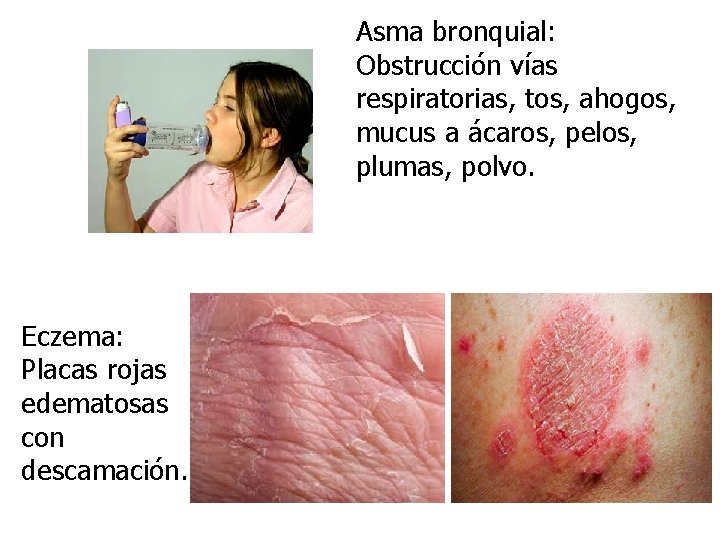 Asma bronquial: Obstrucción vías respiratorias, tos, ahogos, mucus a ácaros, pelos, plumas, polvo. Eczema: