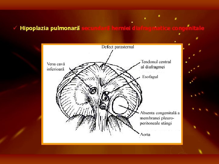 ü Hipoplazia pulmonară secundară herniei diafragmatice congenitale 