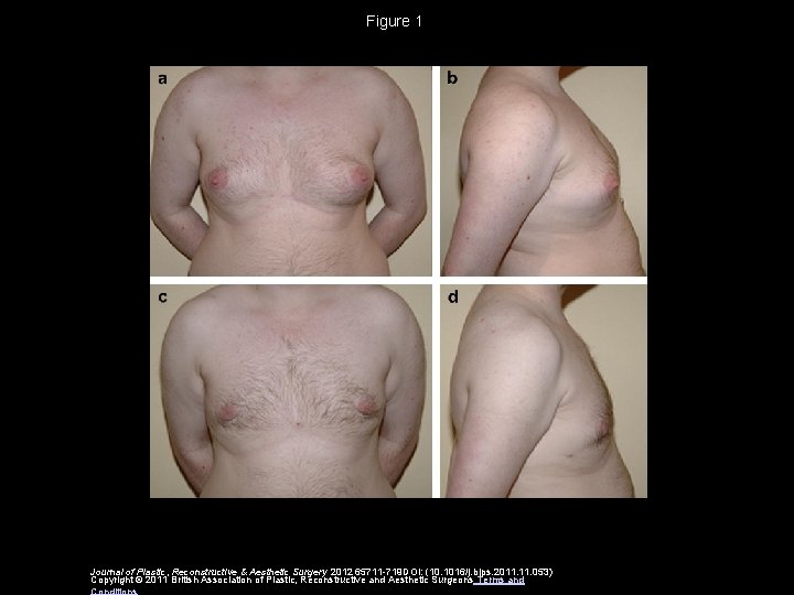 Figure 1 Journal of Plastic, Reconstructive & Aesthetic Surgery 2012 65711 -719 DOI: (10.