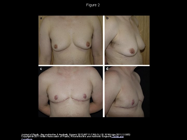 Figure 2 Journal of Plastic, Reconstructive & Aesthetic Surgery 2012 65711 -719 DOI: (10.