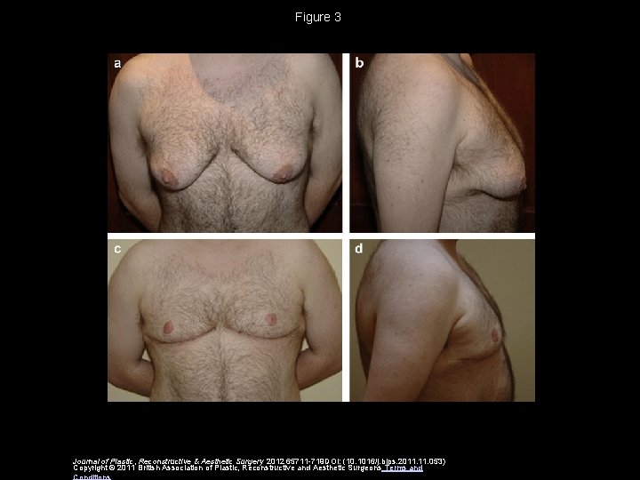 Figure 3 Journal of Plastic, Reconstructive & Aesthetic Surgery 2012 65711 -719 DOI: (10.