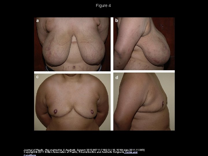 Figure 4 Journal of Plastic, Reconstructive & Aesthetic Surgery 2012 65711 -719 DOI: (10.